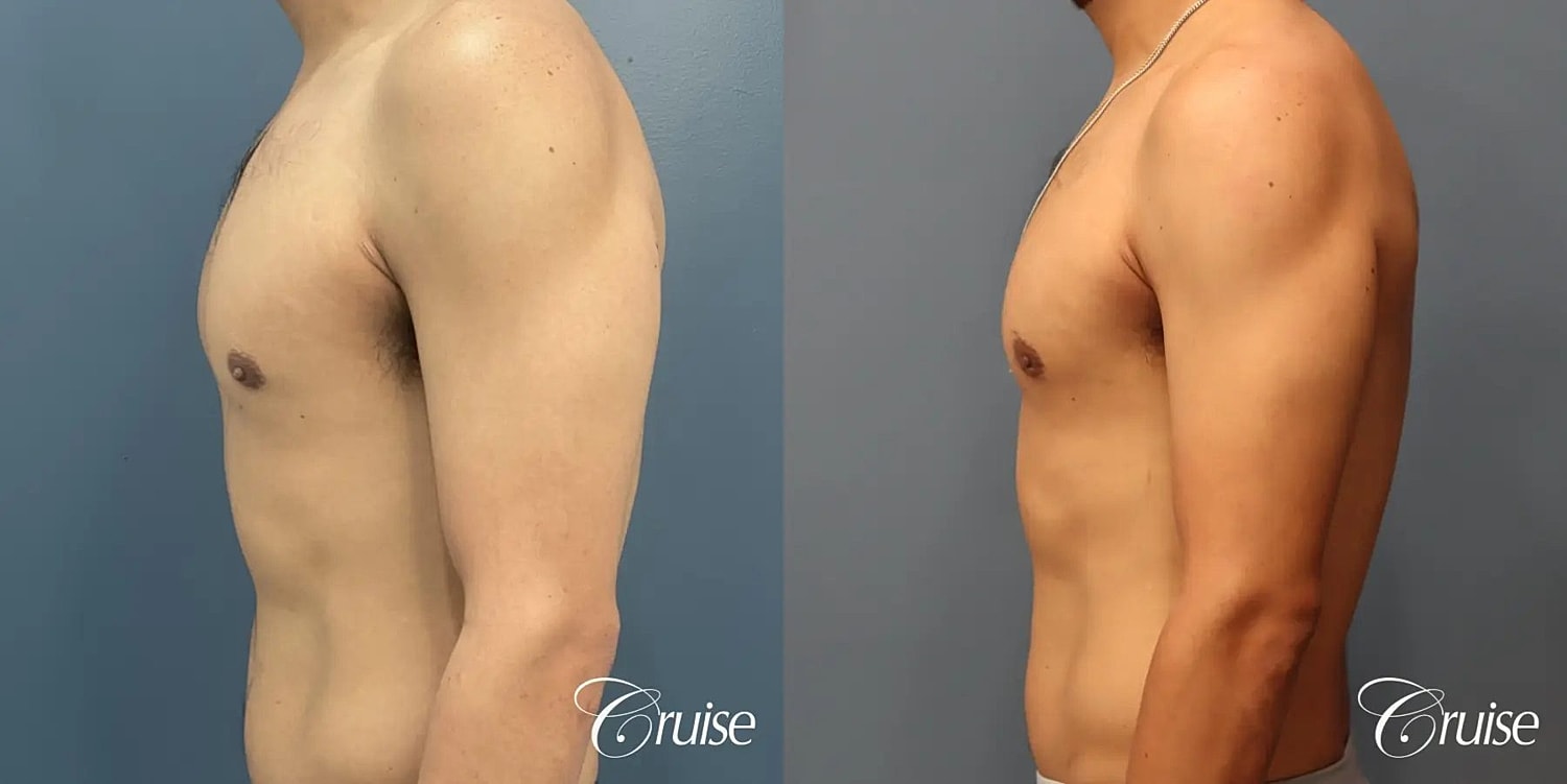 Gynecomastia Before & After
