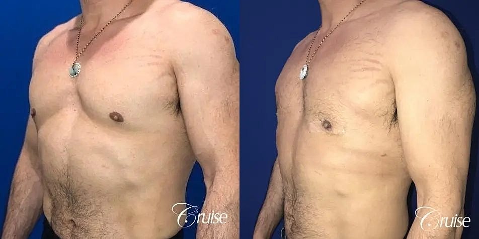 Gynecomastia Before & After