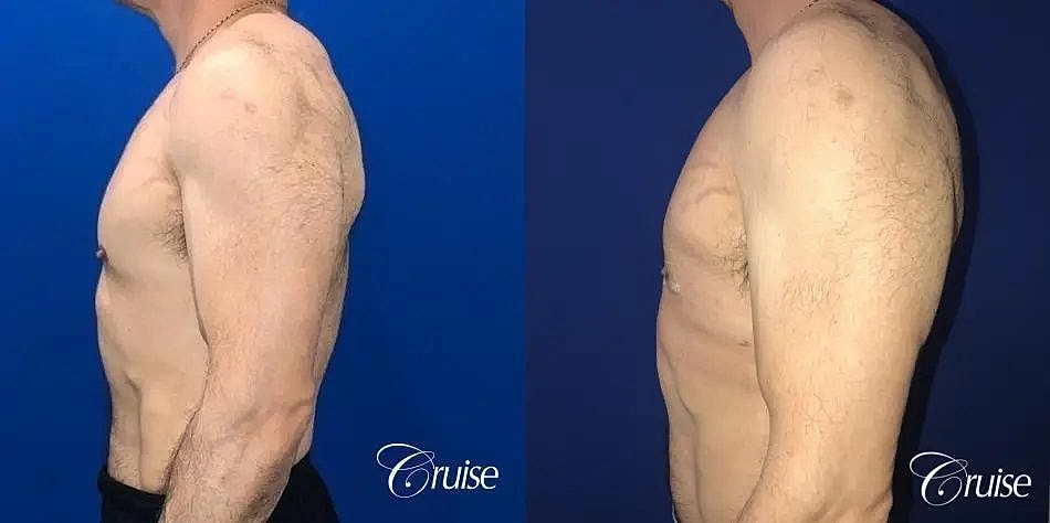 Gynecomastia Before & After