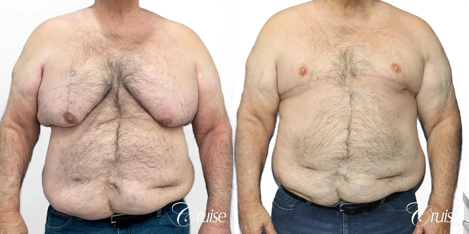 Gynecomastia Before & After