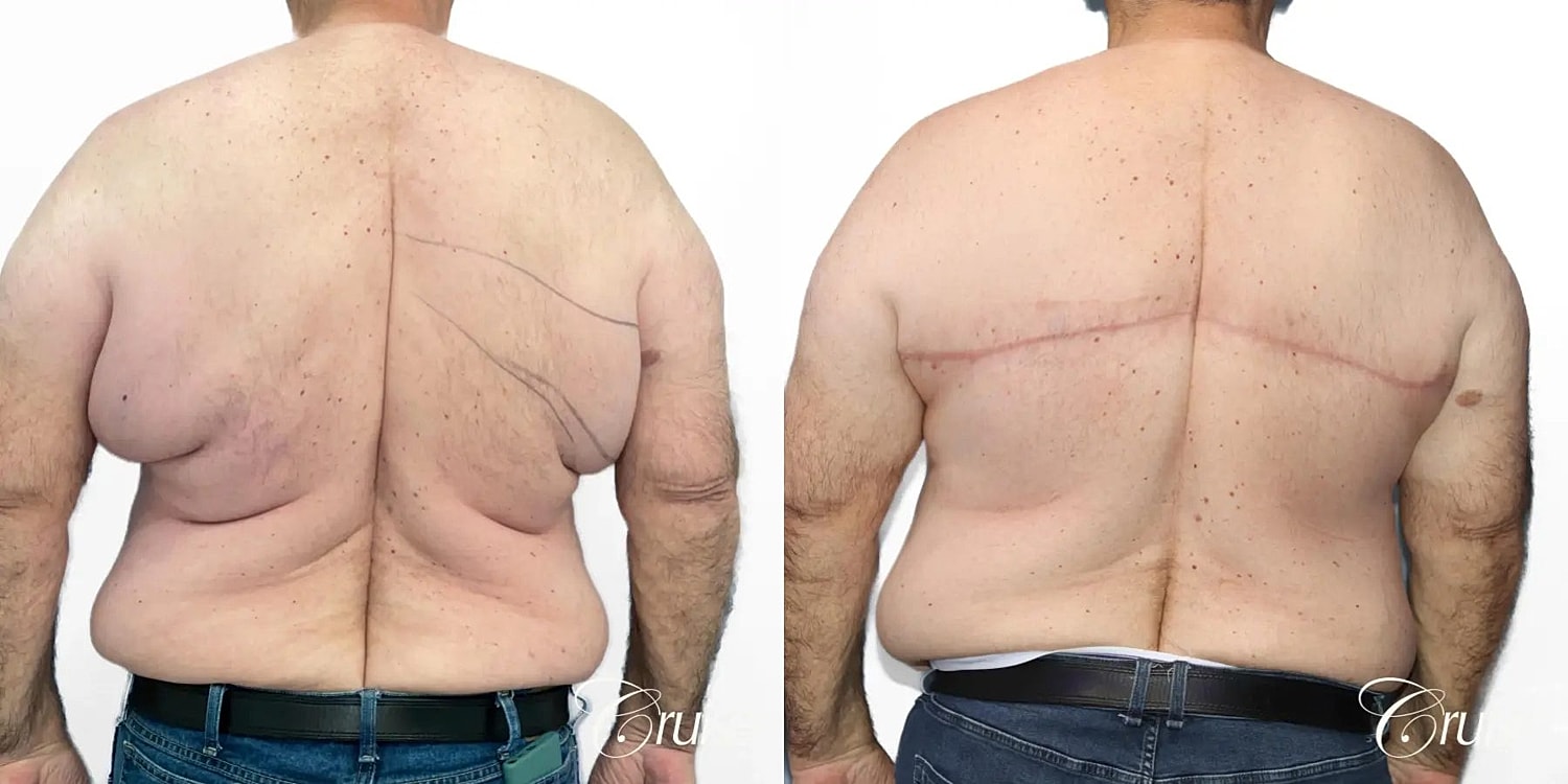 Gynecomastia Before & After