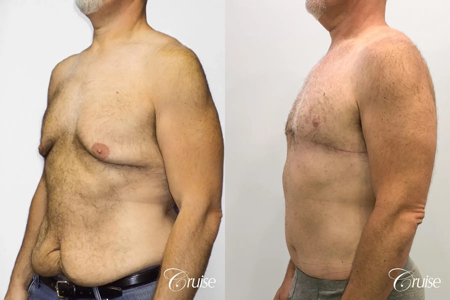 Gynecomastia Before & After