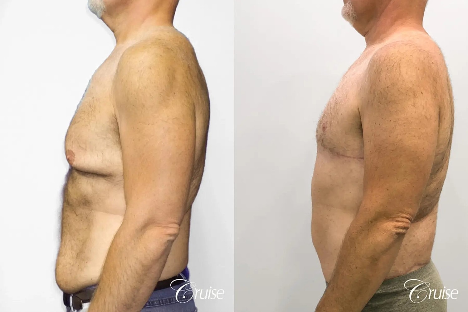 Gynecomastia Before & After