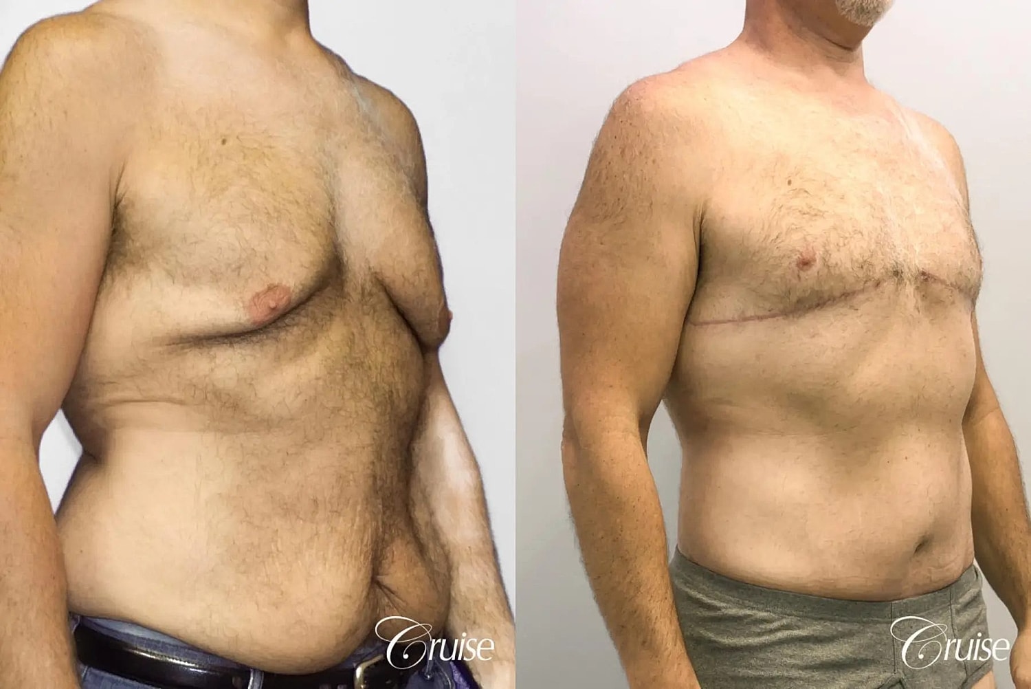 Gynecomastia Before & After