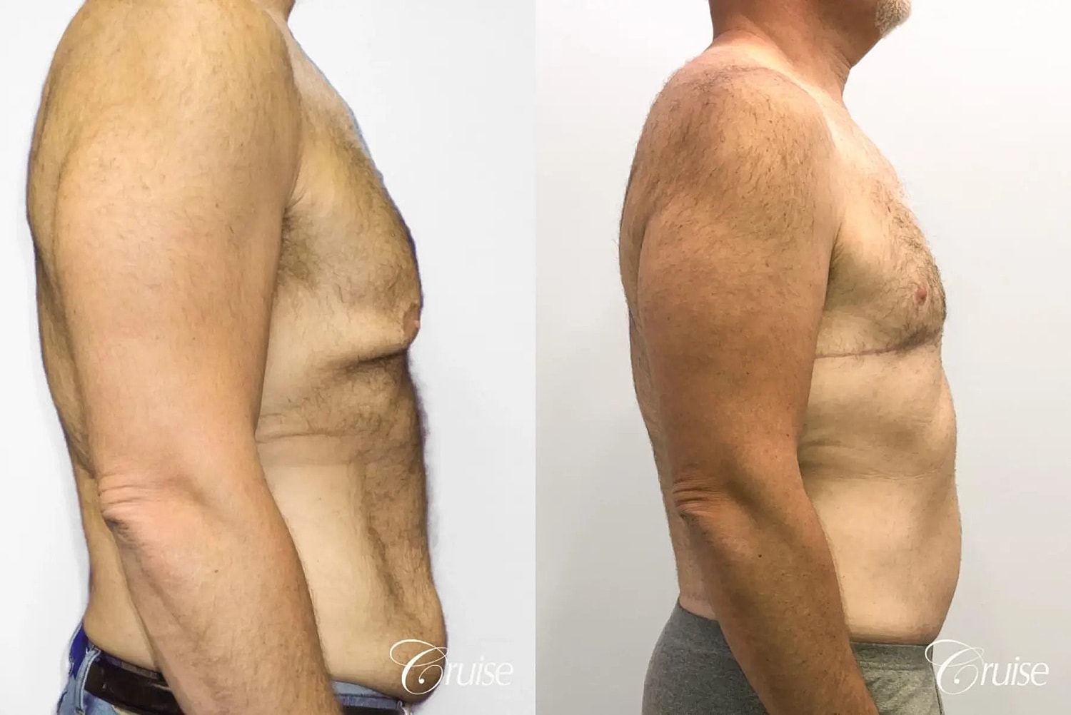 Gynecomastia Before & After