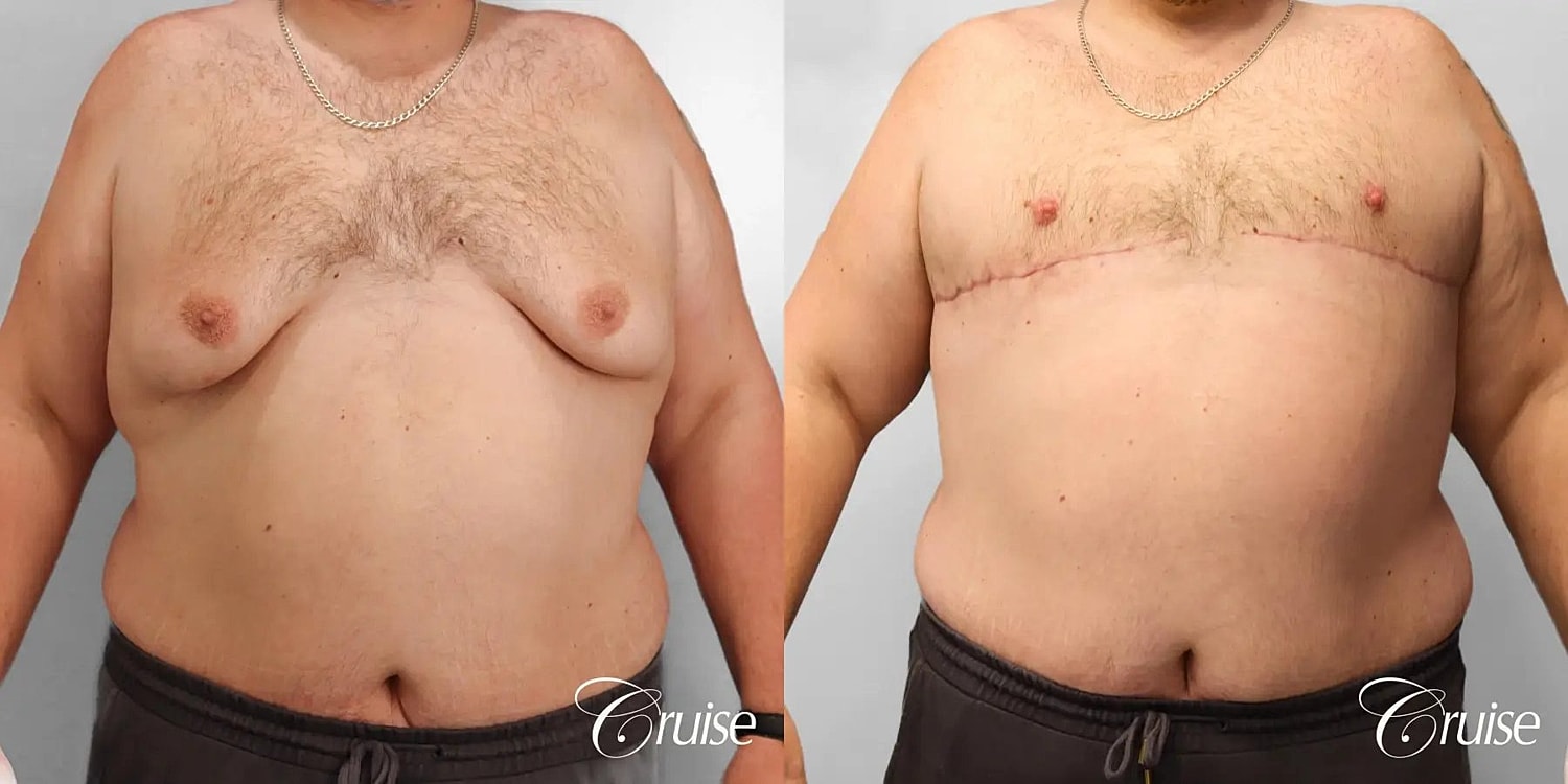 Gynecomastia Before & After