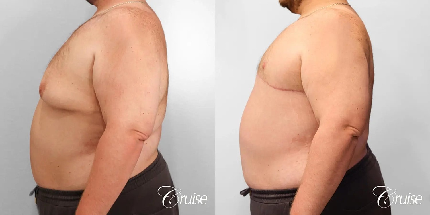 Gynecomastia Before & After