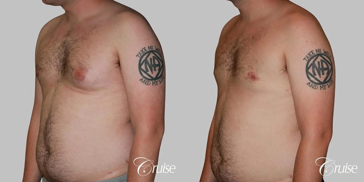 Gynecomastia Before & After