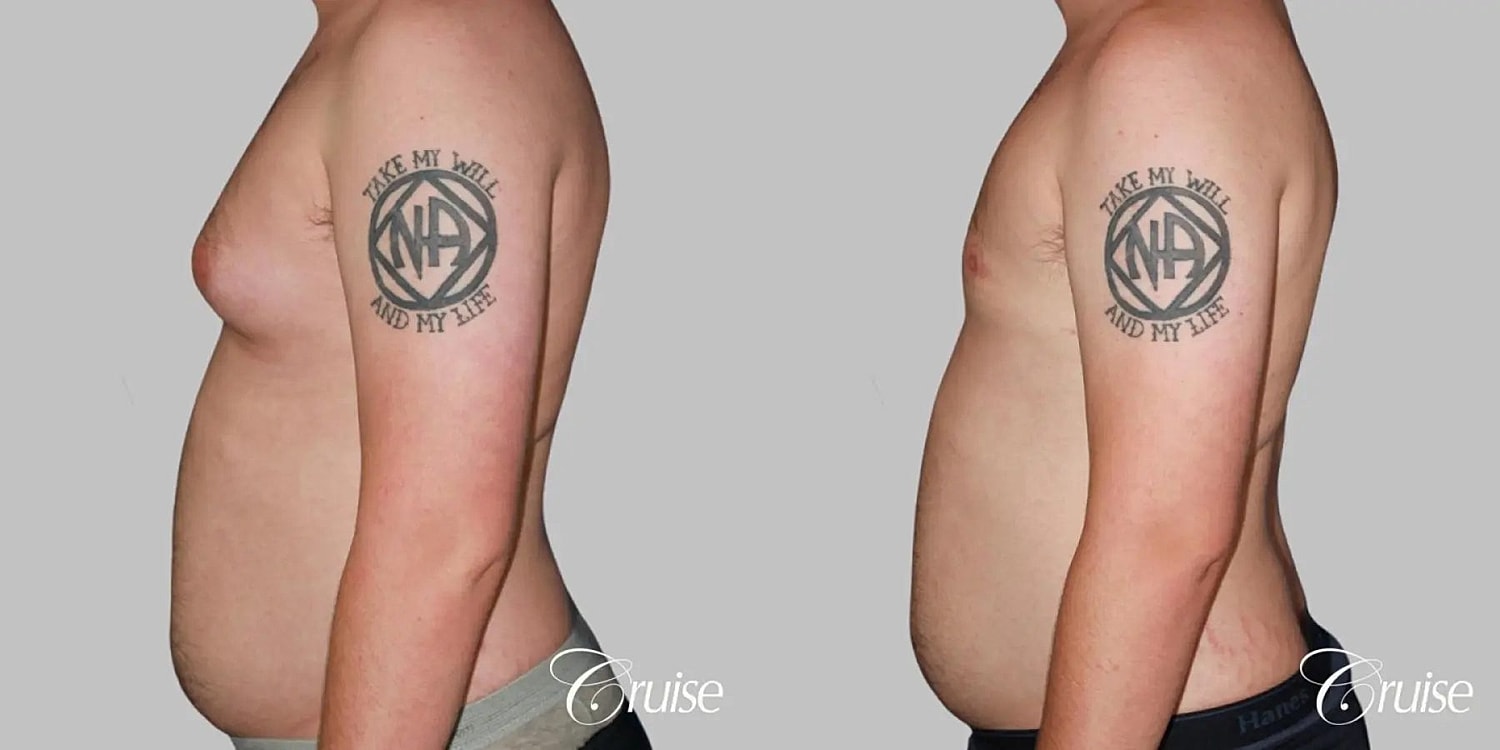 Gynecomastia Before & After