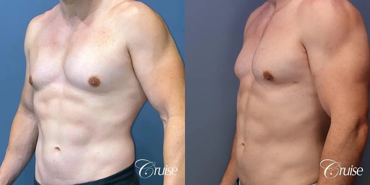 Gynecomastia Before & After