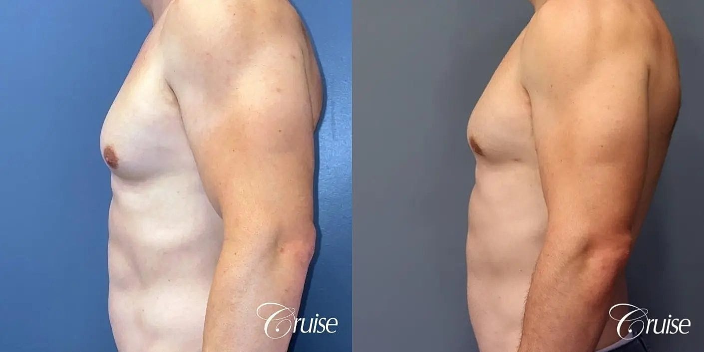Gynecomastia Before & After