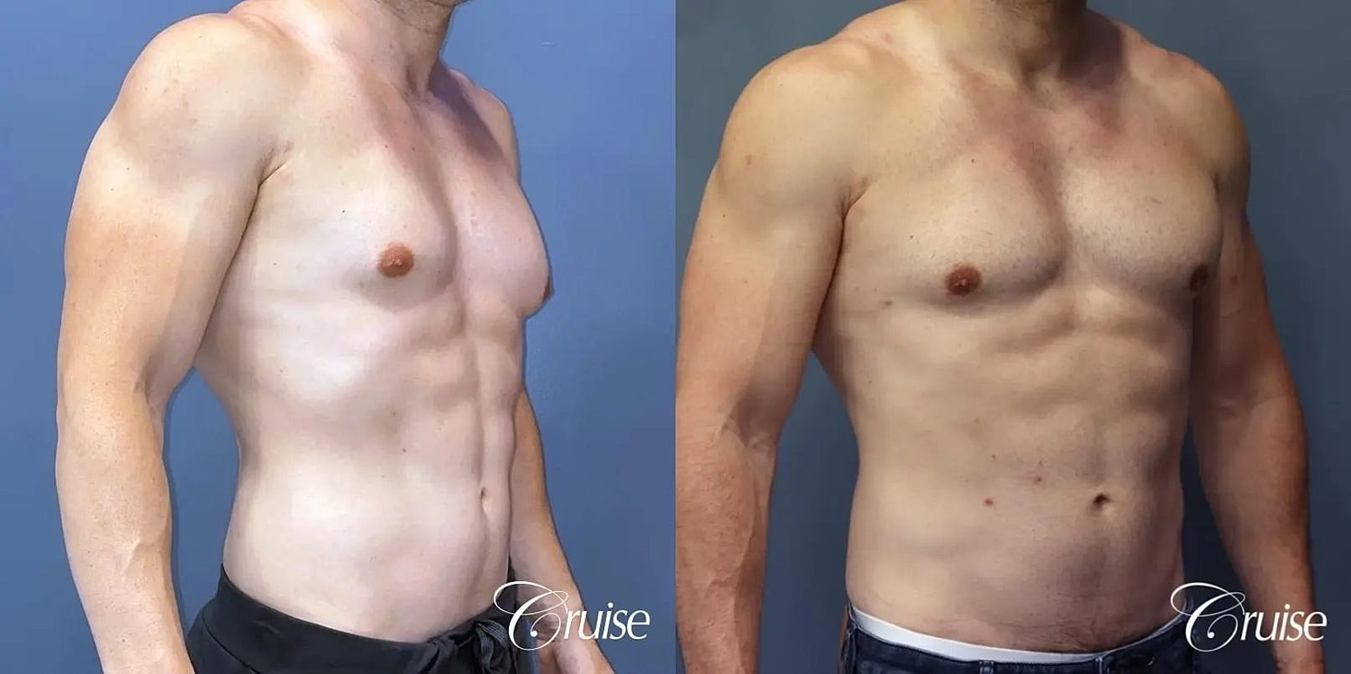 Gynecomastia Before & After