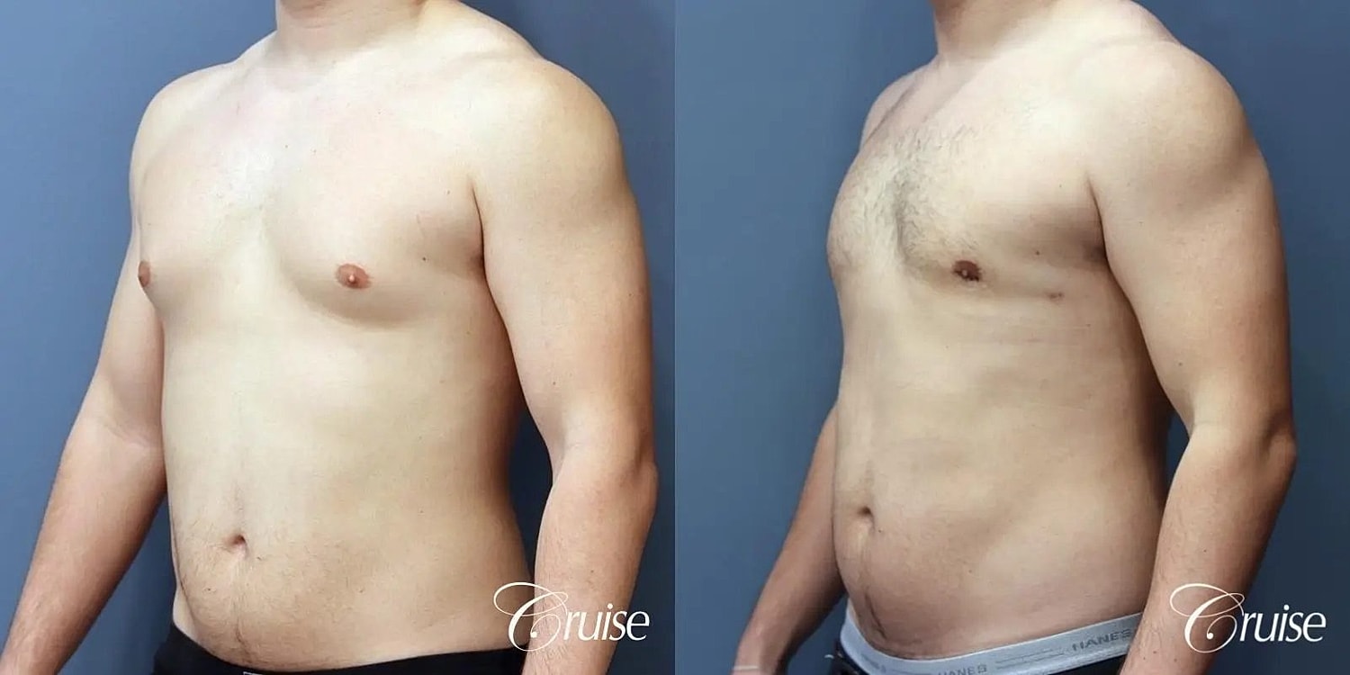 Gynecomastia Before & After