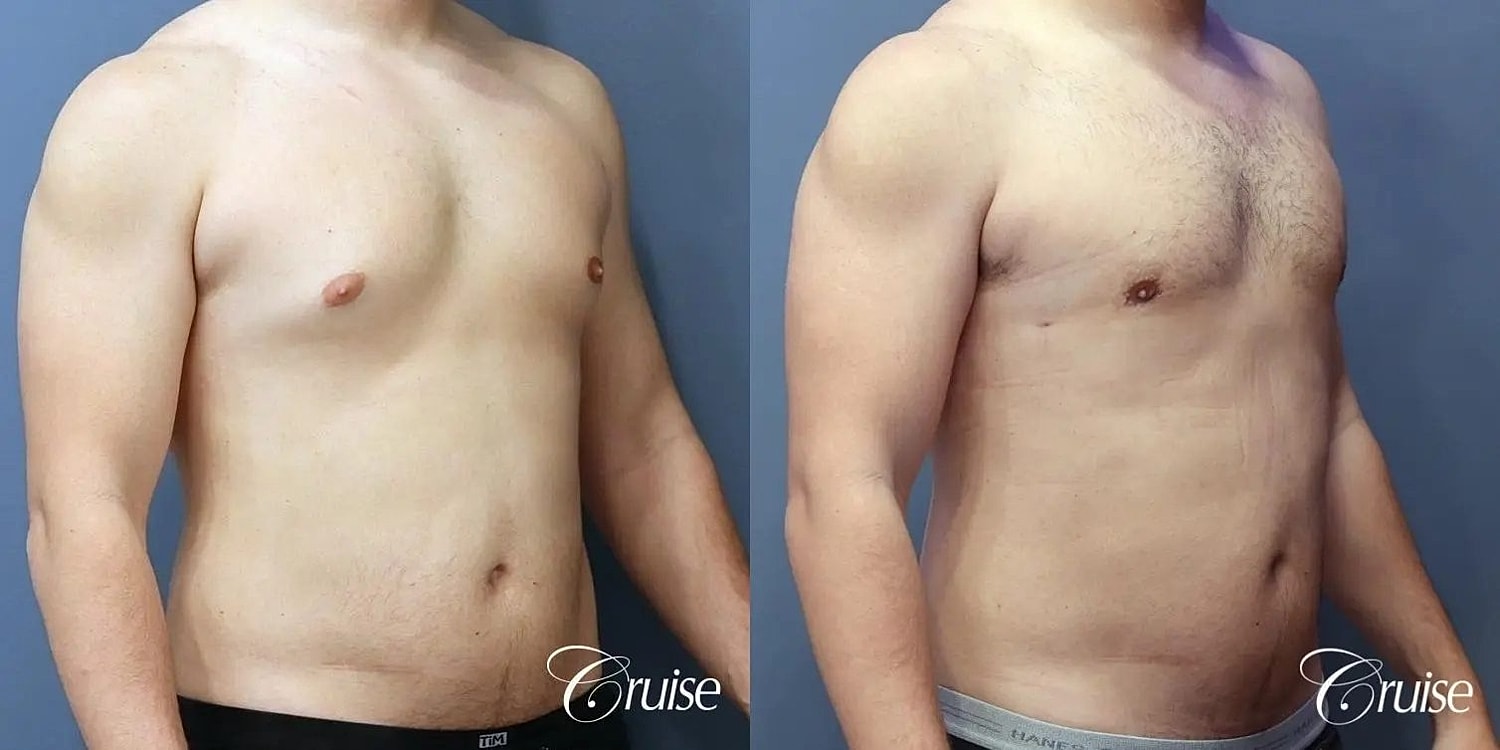 Gynecomastia Before & After