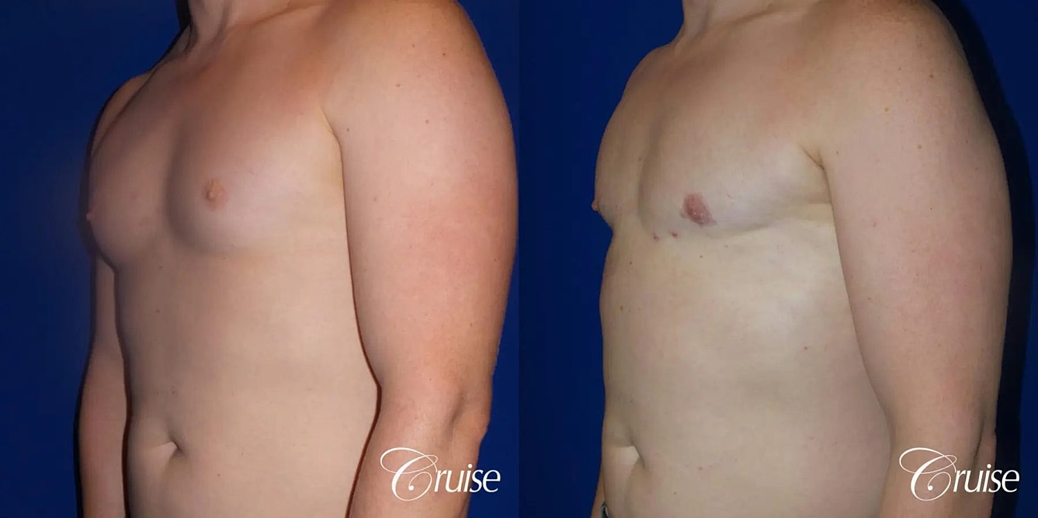 Gynecomastia Before & After