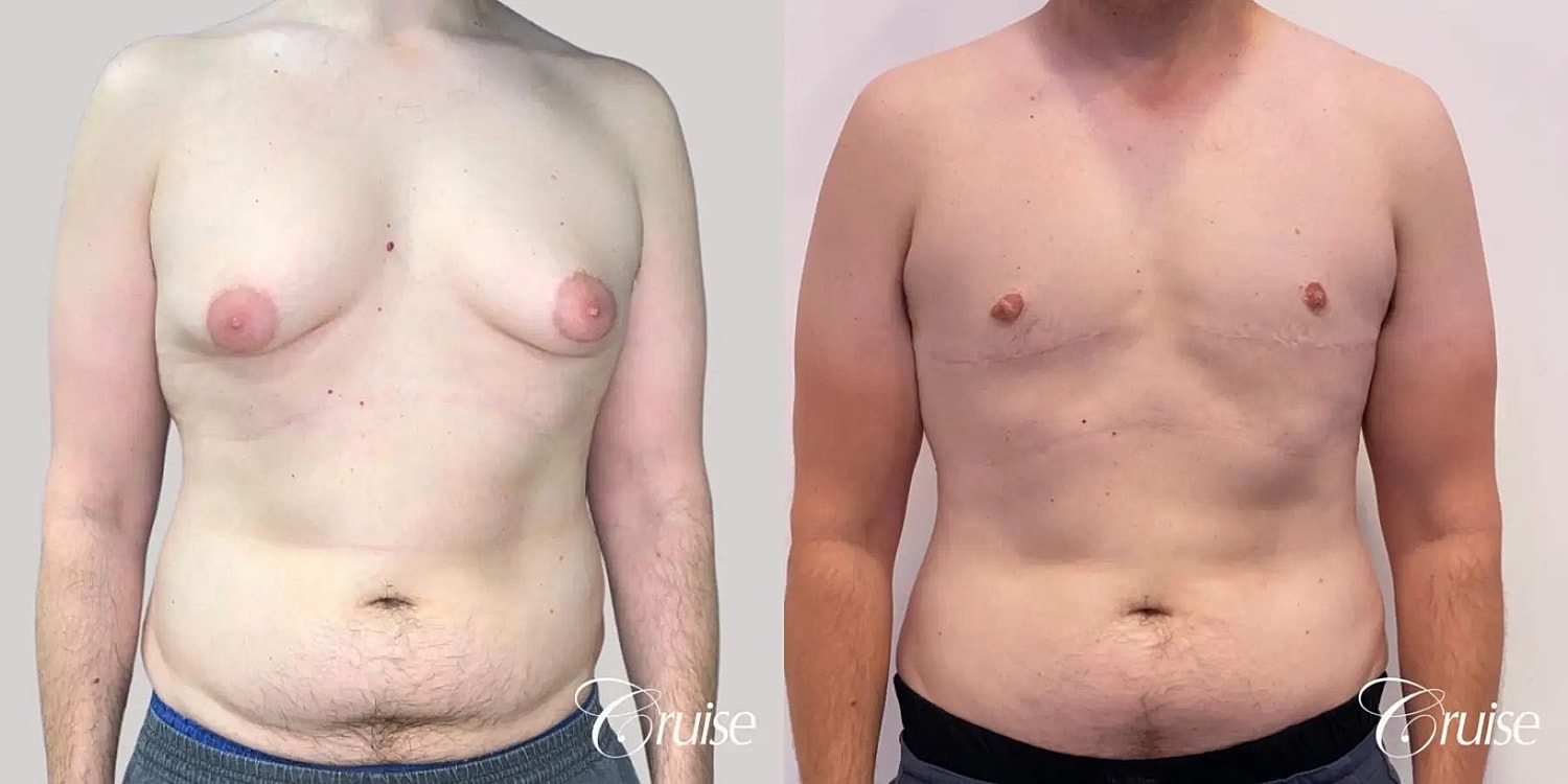 Gynecomastia Before & After