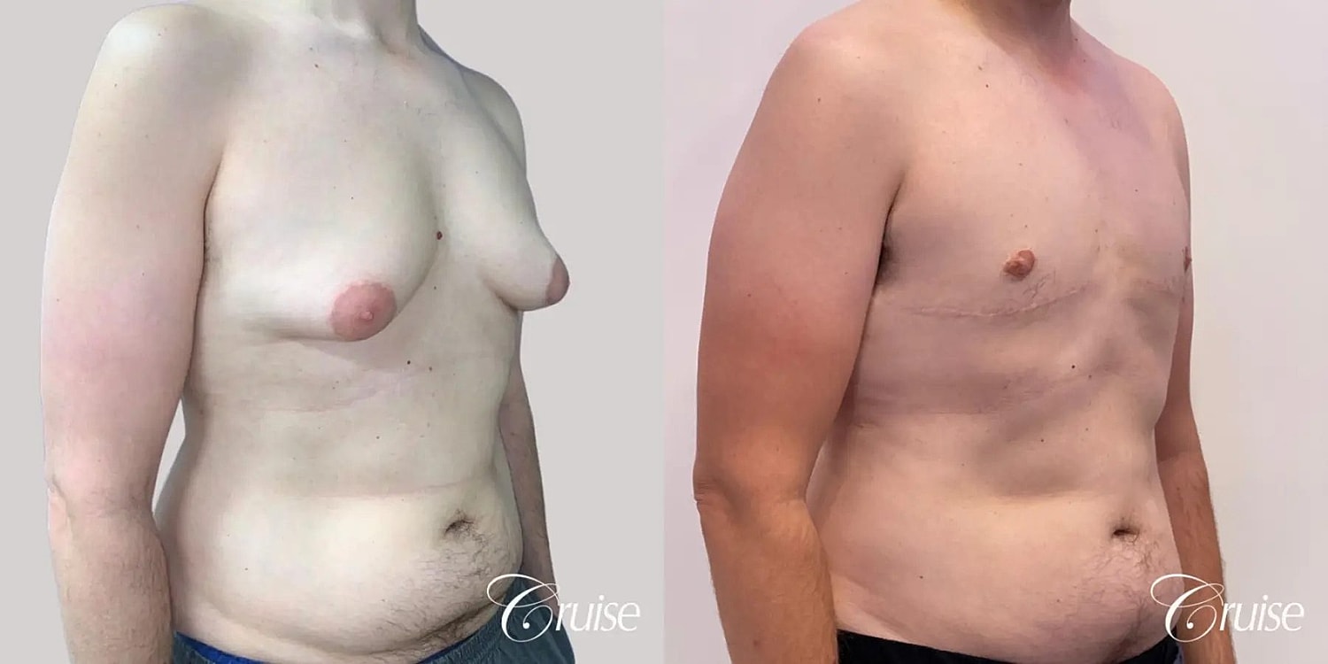 Gynecomastia Before & After