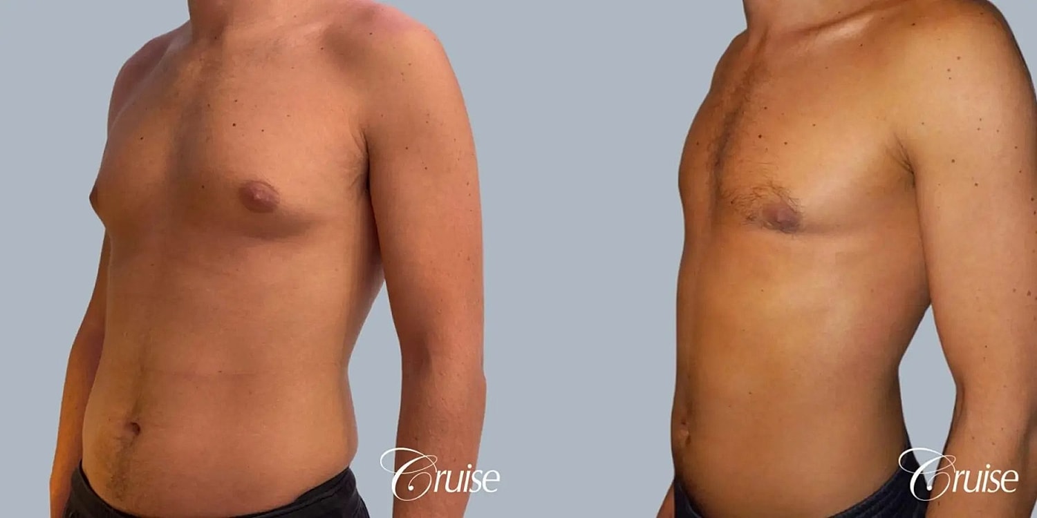 Gynecomastia Before & After