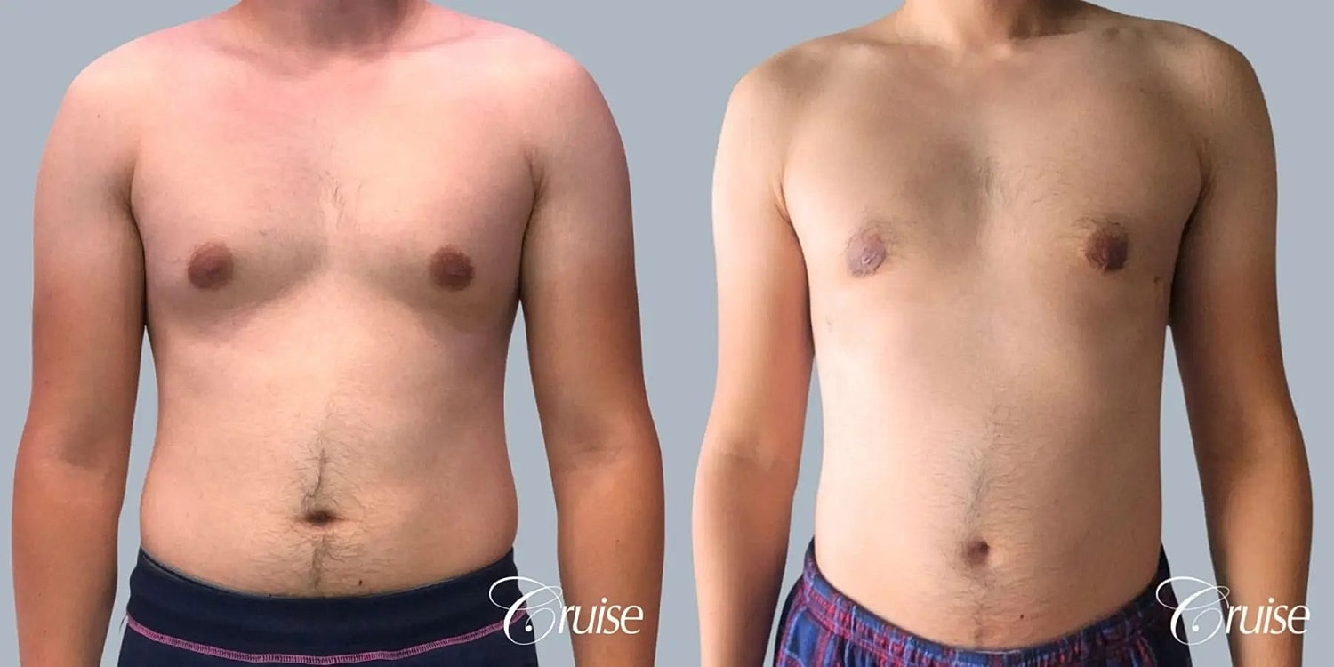 Gynecomastia Before & After