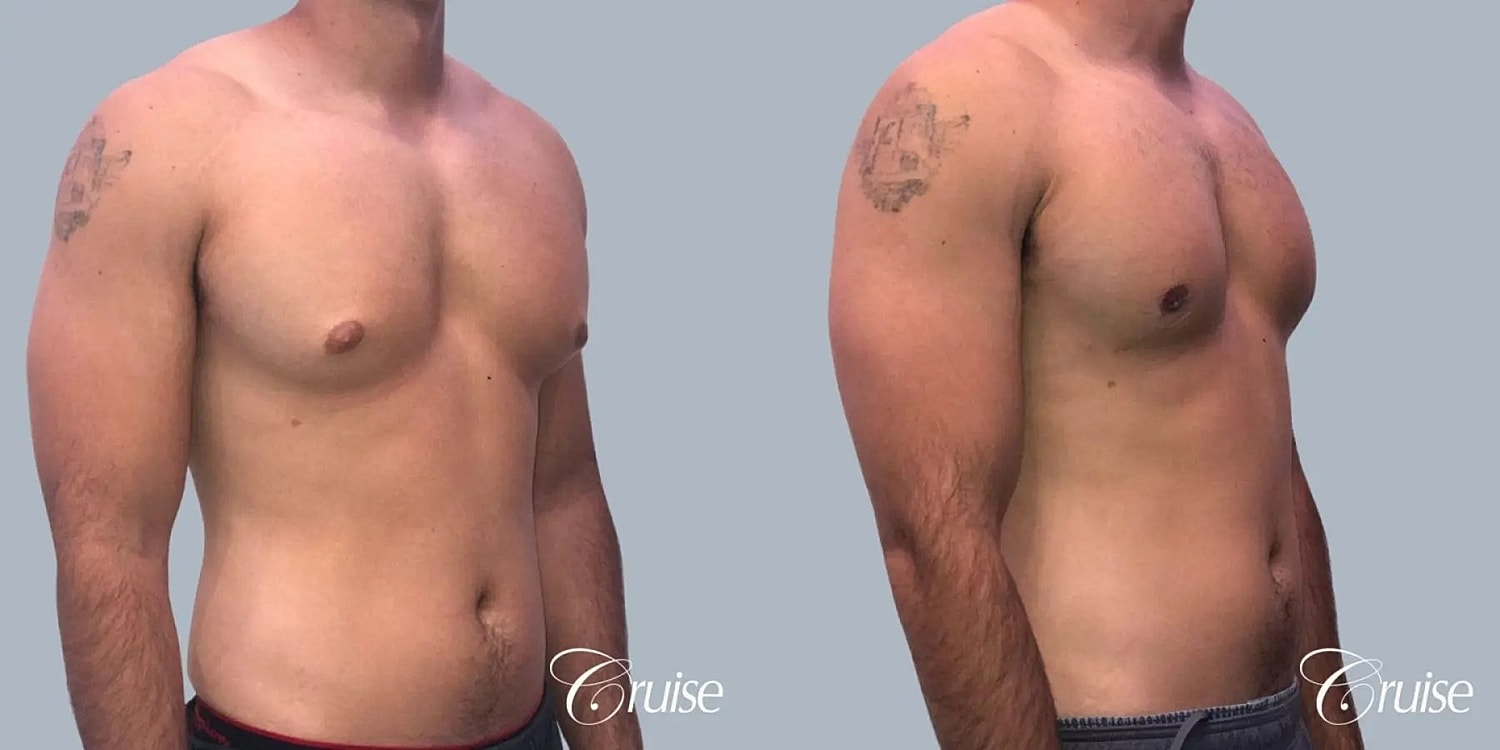 Gynecomastia Before & After