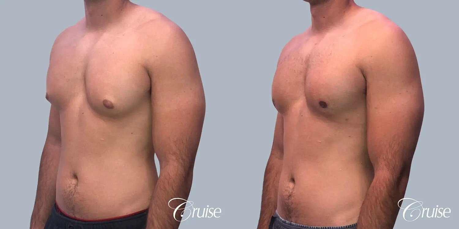 Gynecomastia Before & After