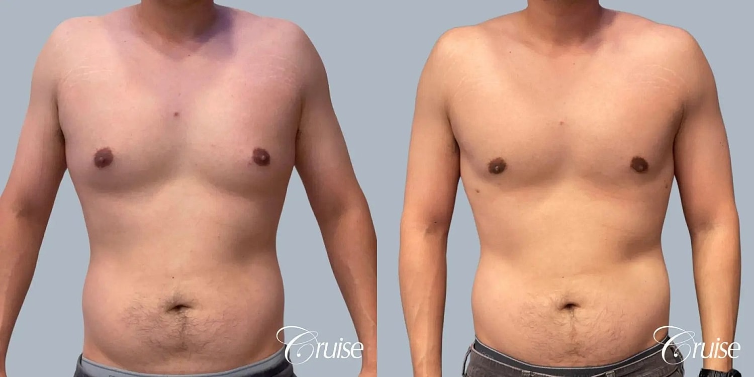 Gynecomastia Before & After