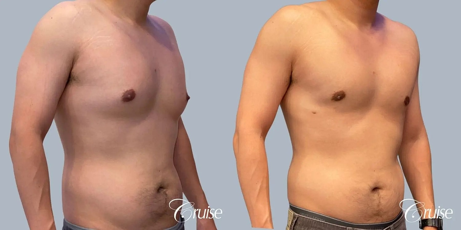 Gynecomastia Before & After