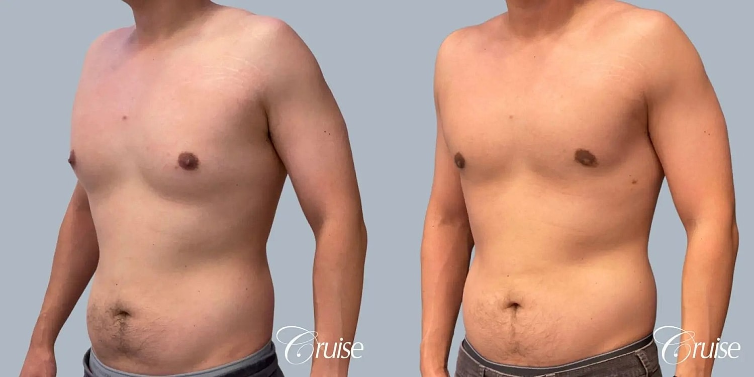 Gynecomastia Before & After