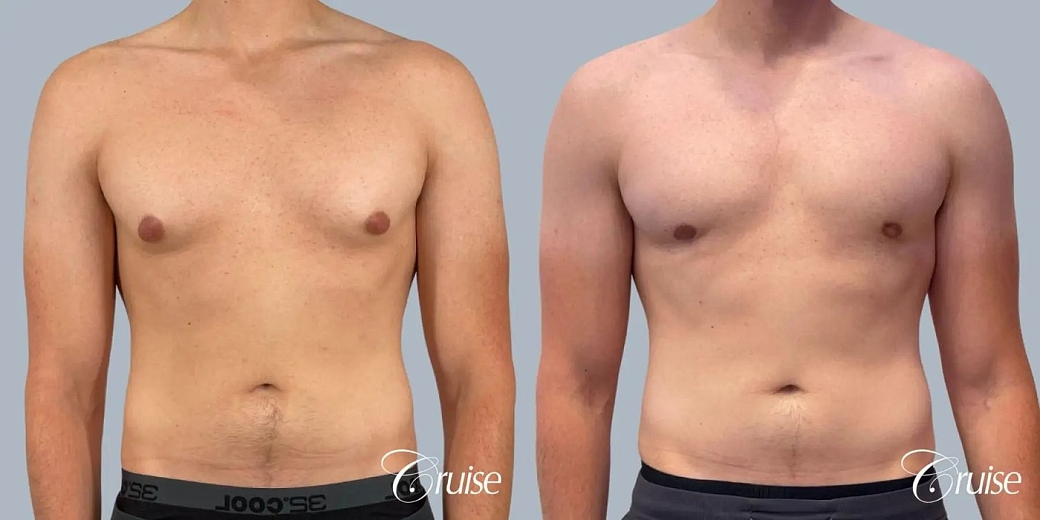 Gynecomastia Before & After