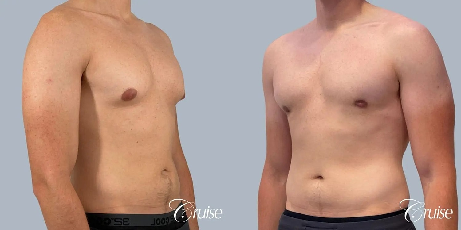 Gynecomastia Before & After