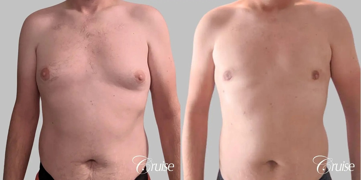 Gynecomastia Before & After