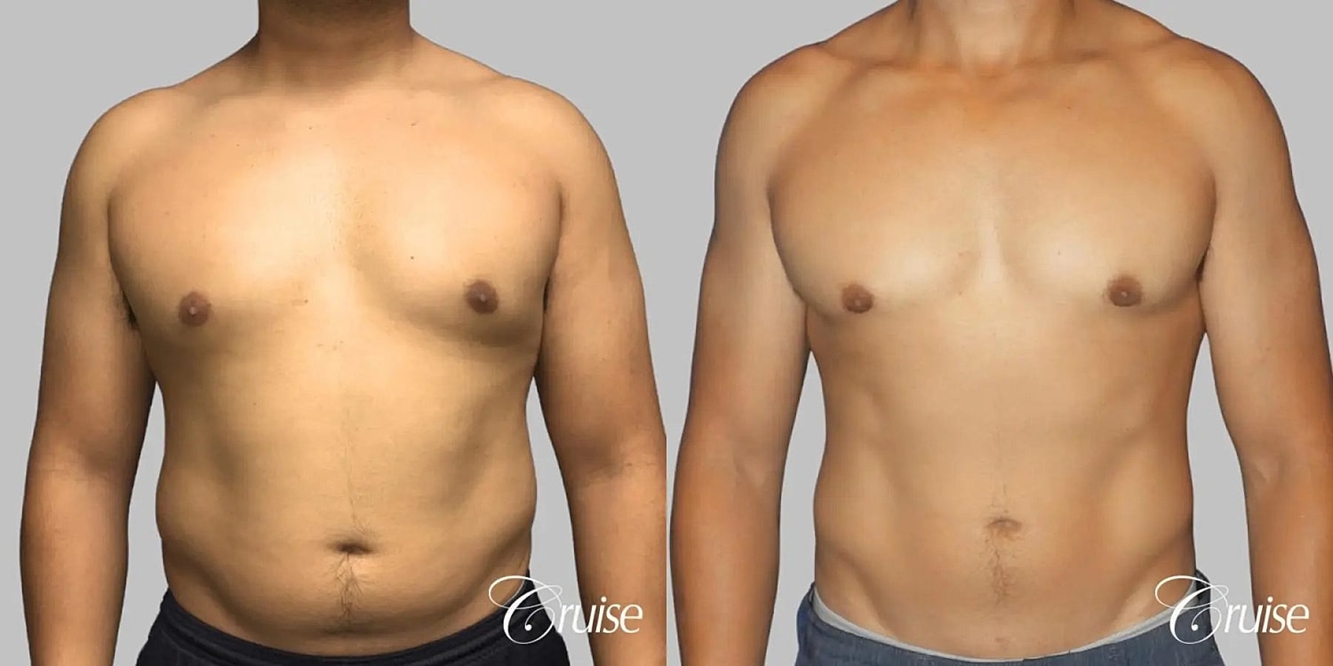 Gynecomastia Before & After