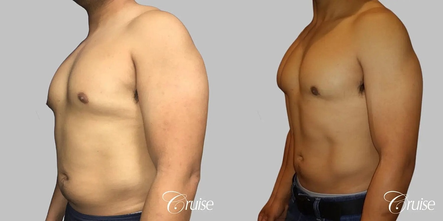 Gynecomastia Before & After