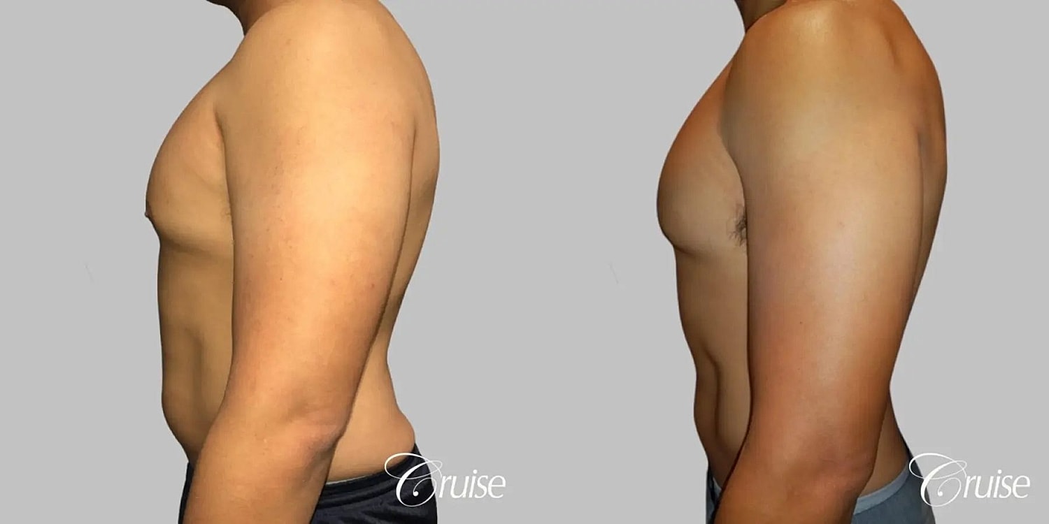 Gynecomastia Before & After