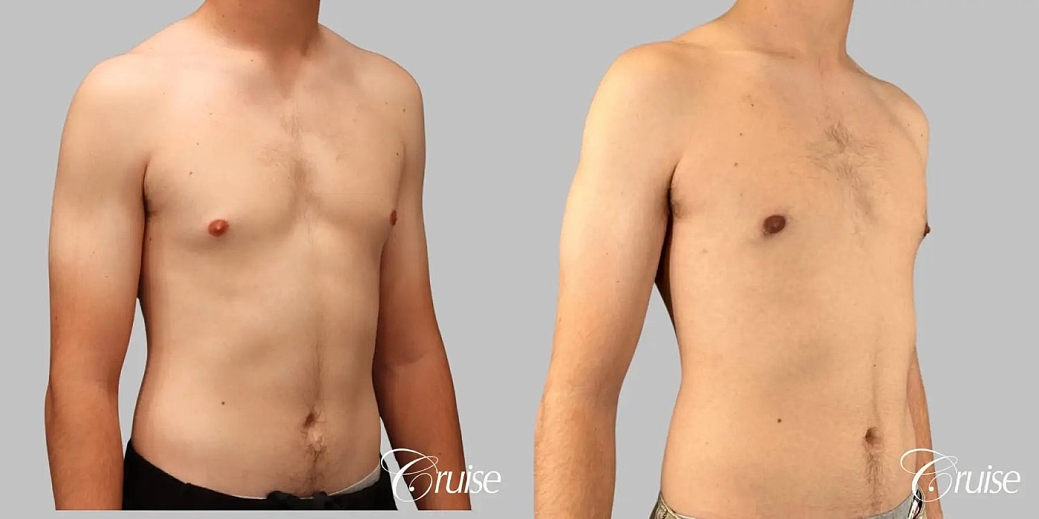 Gynecomastia Before & After