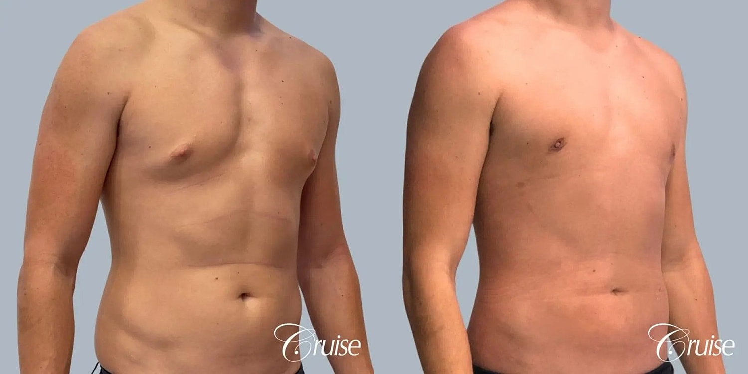 Gynecomastia Before & After
