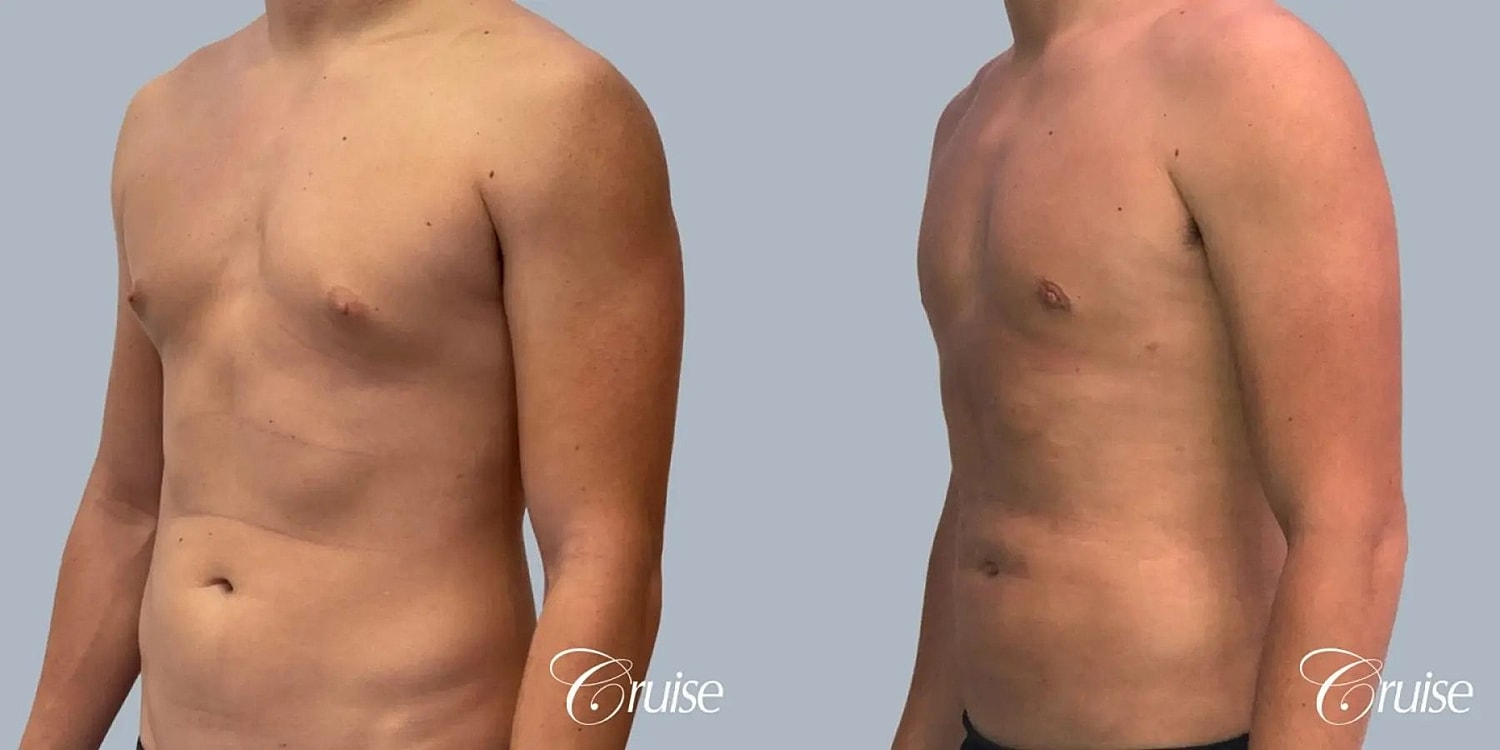 Gynecomastia Before & After