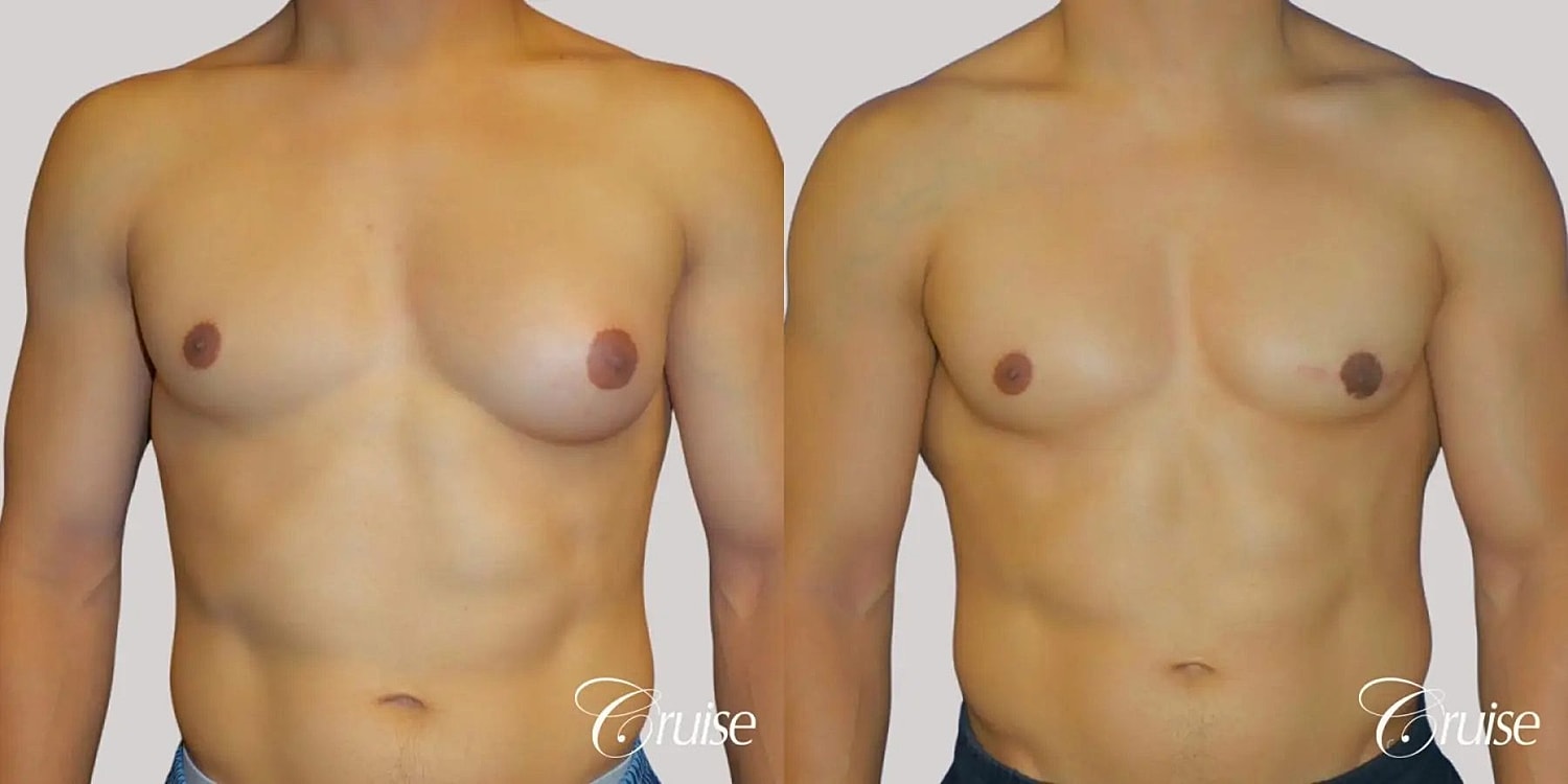 Gynecomastia Before & After