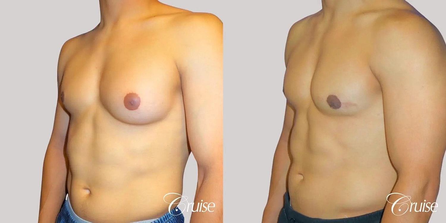 Gynecomastia Before & After