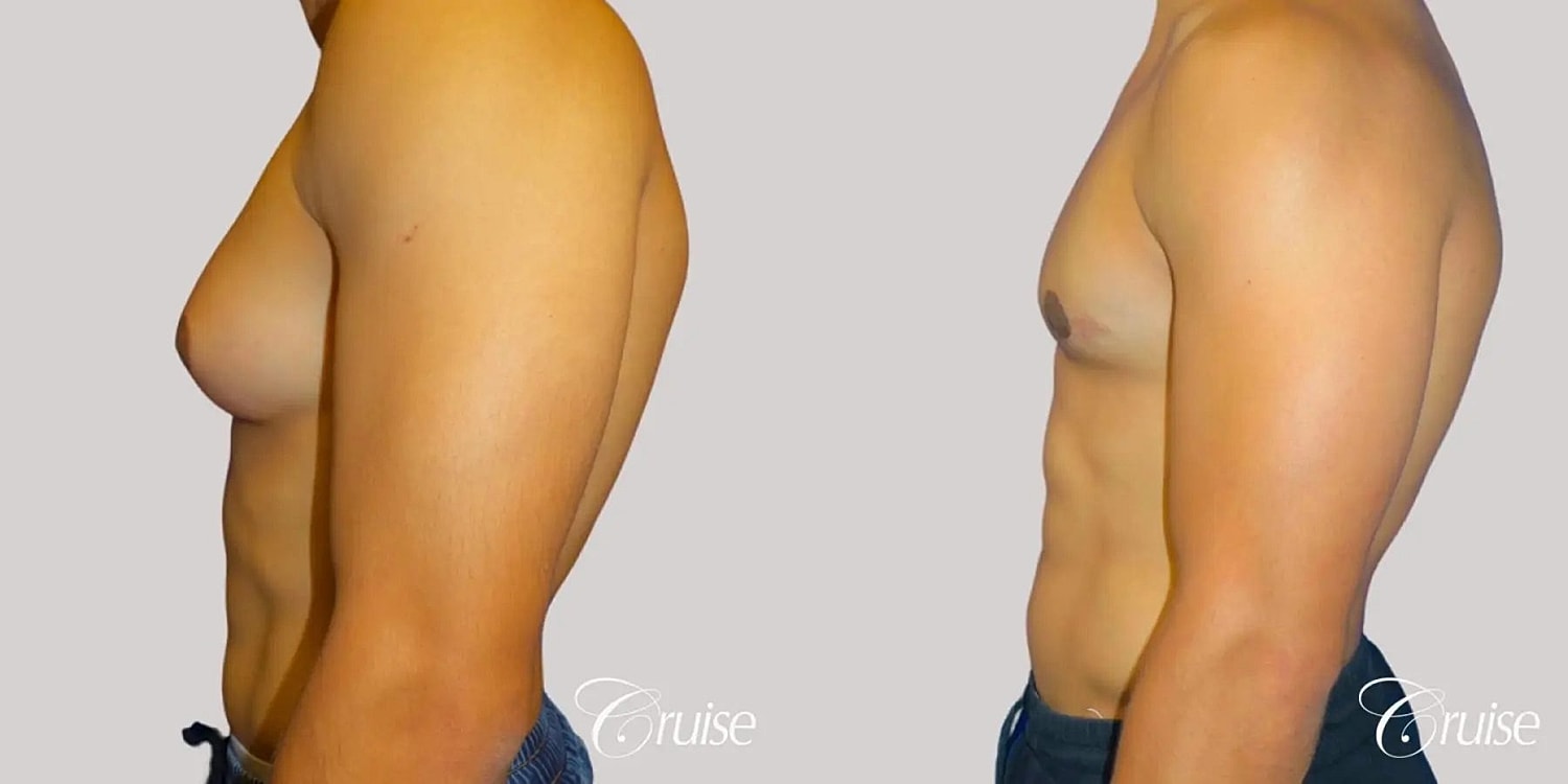 Gynecomastia Before & After