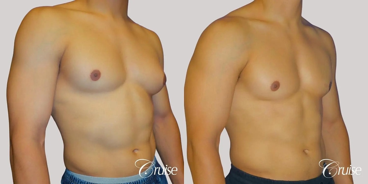 Gynecomastia Before & After