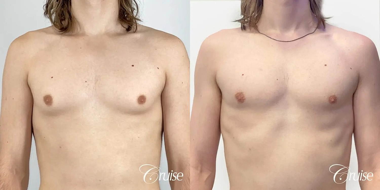 Gynecomastia Before & After