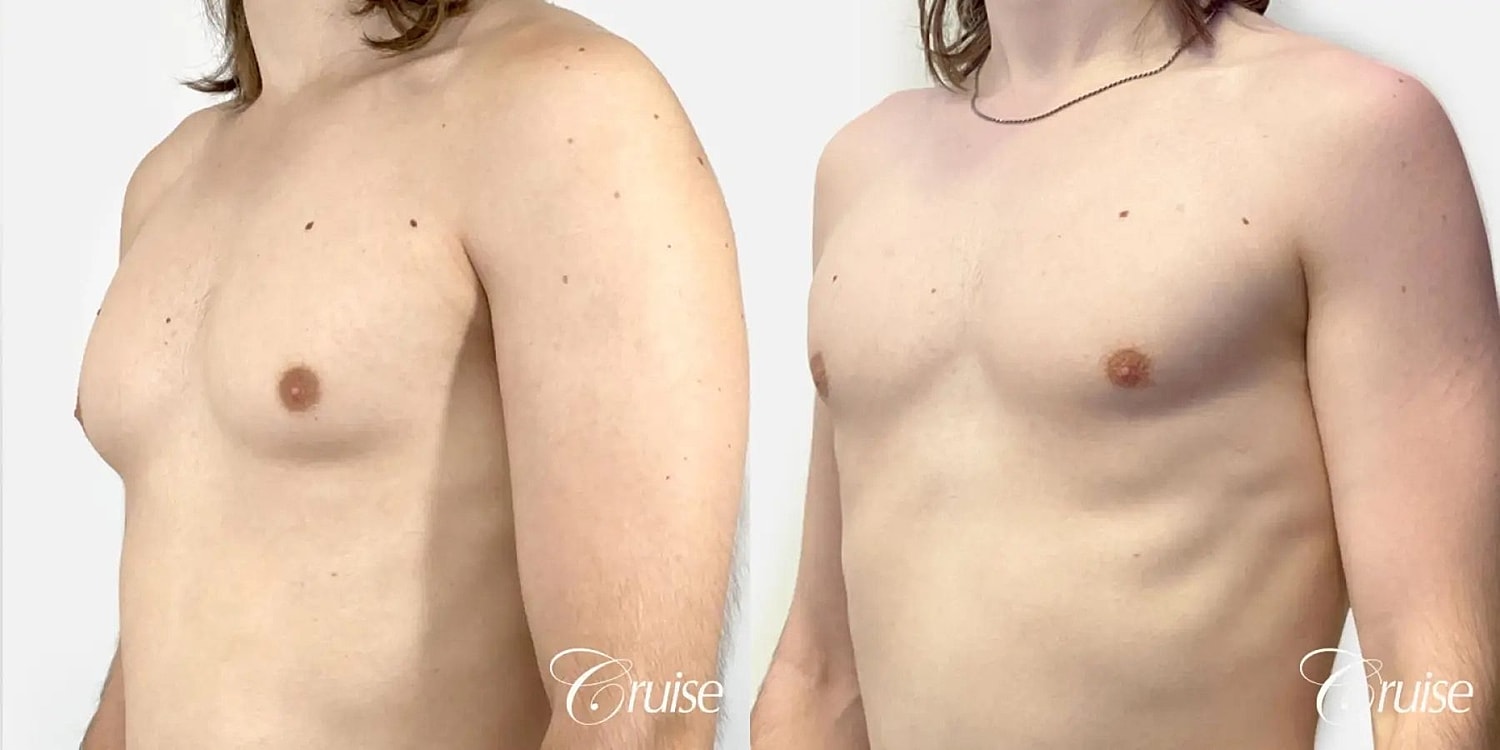 Gynecomastia Before & After