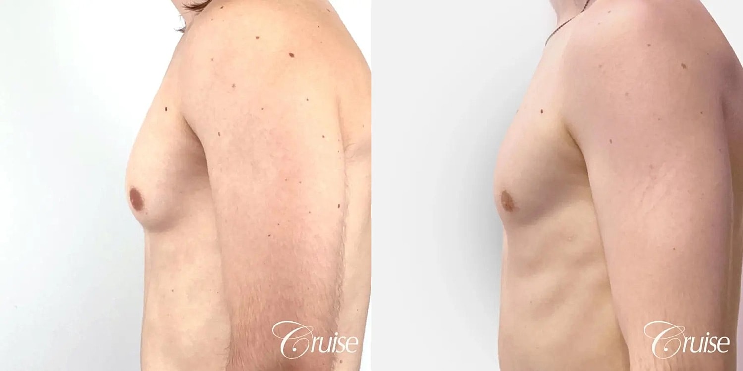 Gynecomastia Before & After