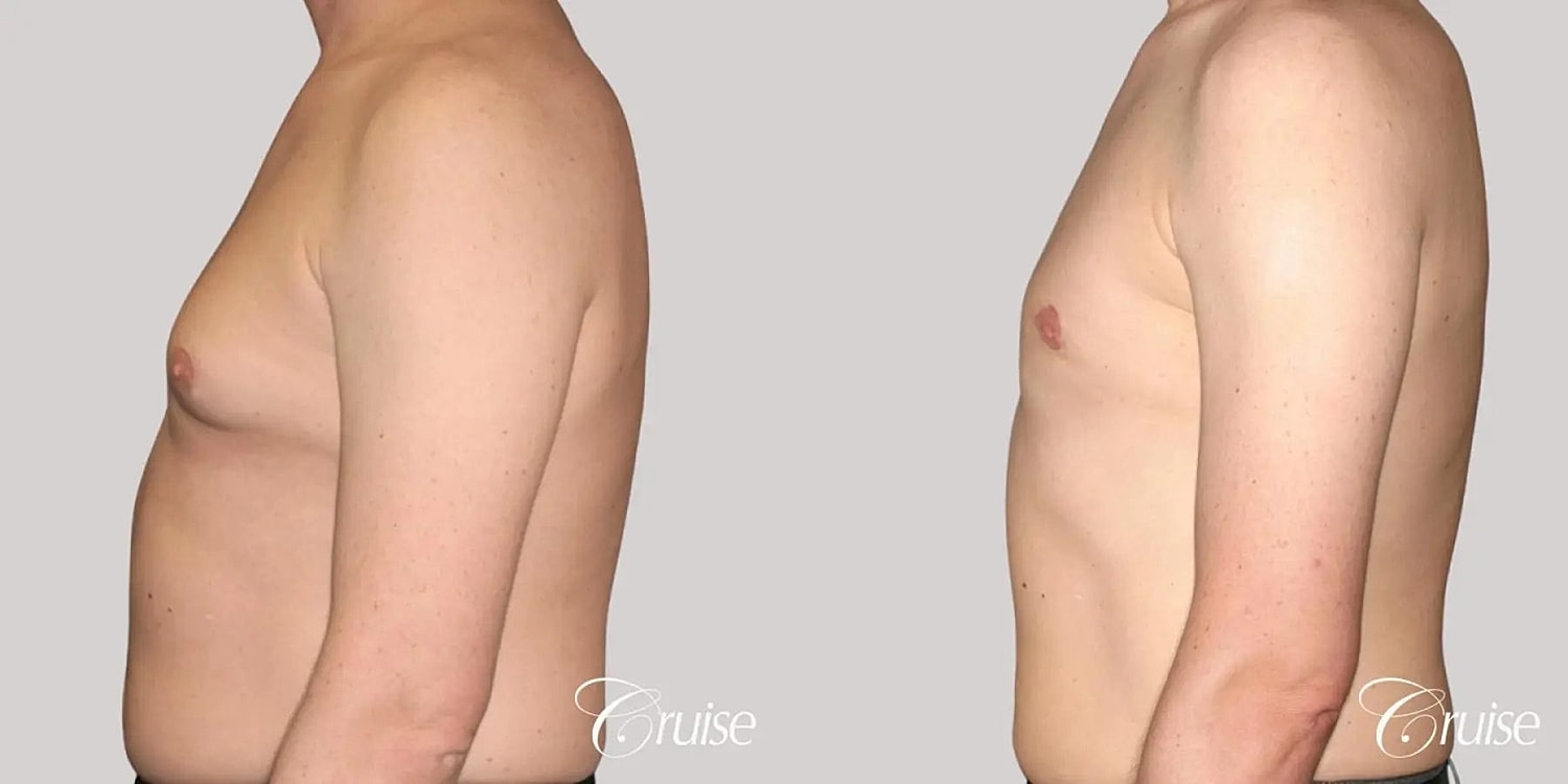 Gynecomastia Before & After