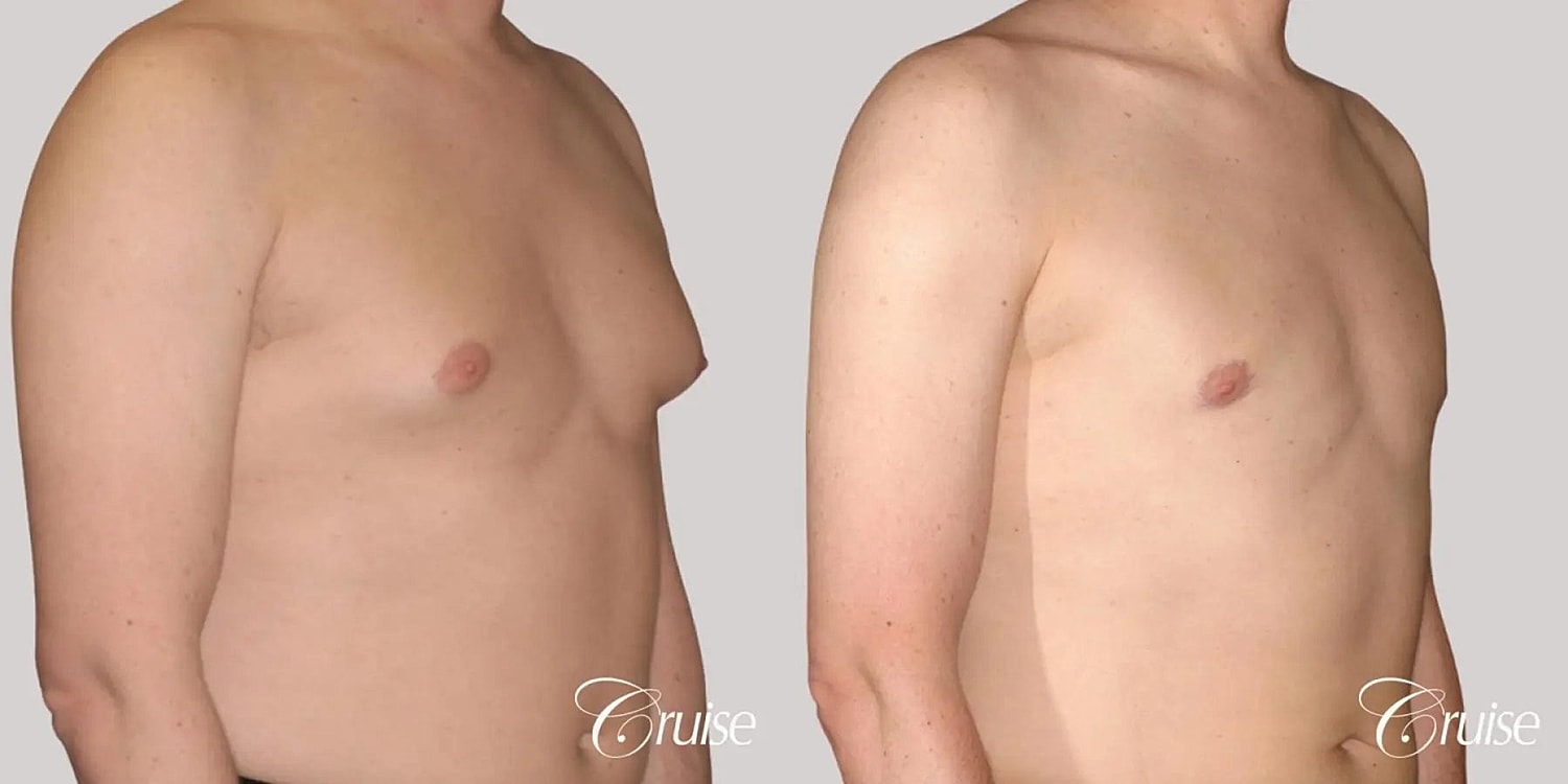 Gynecomastia Before & After