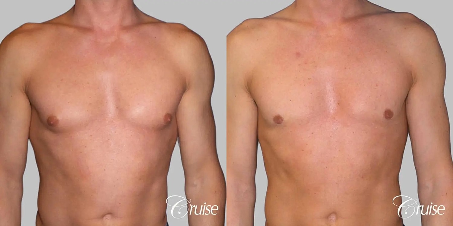 Gynecomastia Before & After
