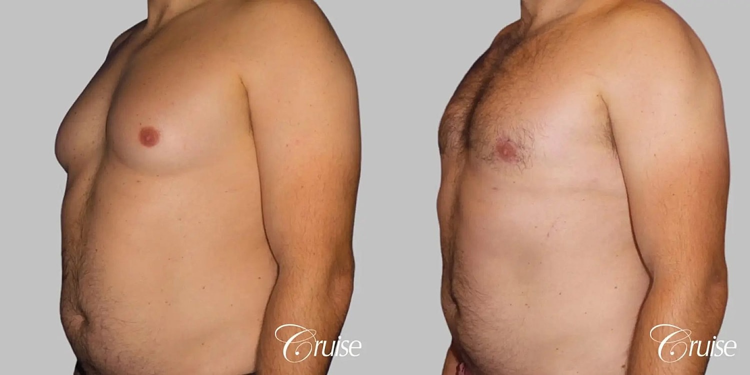 Gynecomastia Before & After
