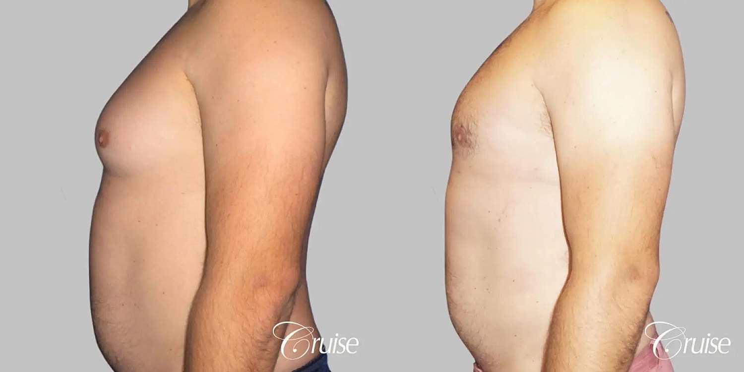 Gynecomastia Before & After