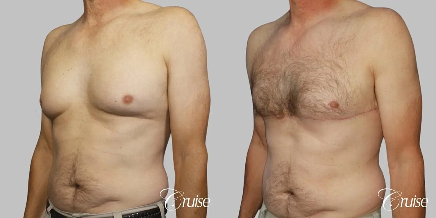 Gynecomastia Before & After